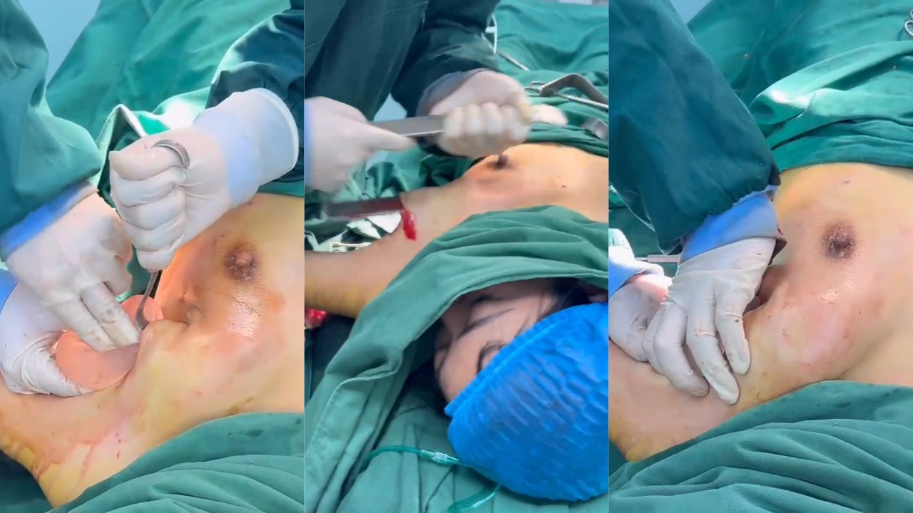 青岛市北医疗隆胸手术完整视频！这血腥程度 集美们还有隆胸的想法吗？血腥慎点